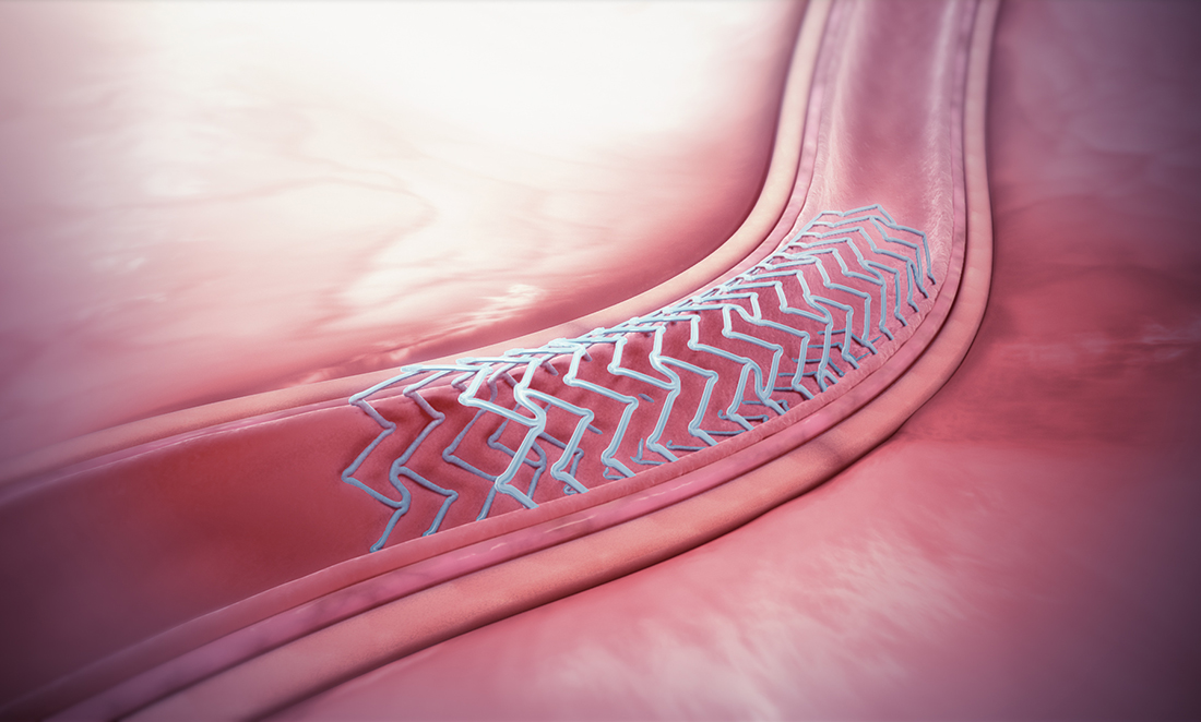 Illustration of a silver stent placed to expand an artery