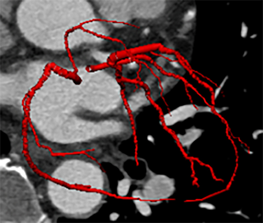 A black and white image showing a red outline of a coronary segmentation from a CT scan