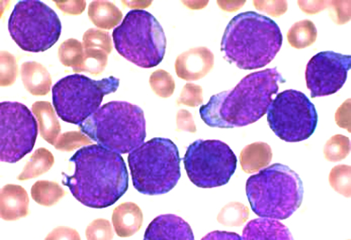 Microscopic image of an acute lymphoblastic leukaemia smear - circular purple shapes surrounded by smaller, orange rings
