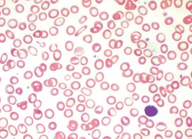 A microscopic image showing iron deficiency in blood - the cells need to be dark red, but these are pale, ring shapes