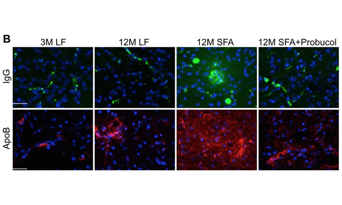 Comparison of 8 images of mice blood-brain barriers at 3 and 12 months – LF is low-fat diet, SFA is a fatty diet, green is IgG antibody (an immune response) and red is toxic beta-amyloid