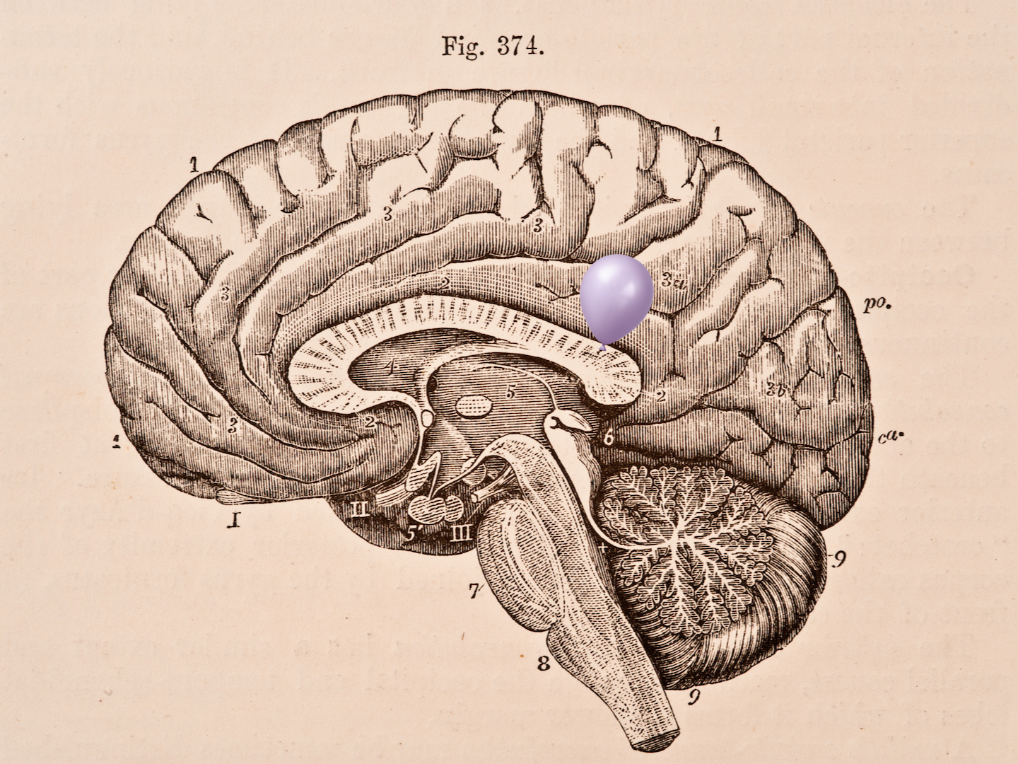 PARTICLE 101: Brain Aneurysms
