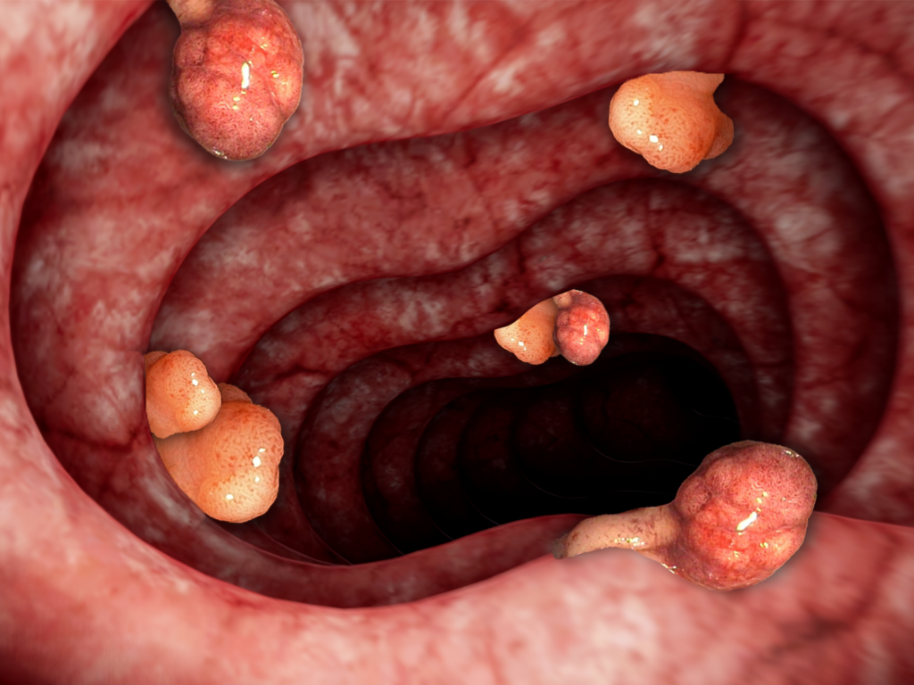 You’re not too young for bowel cancer
